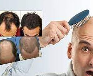 Saç Ekimi Ve Konaklama